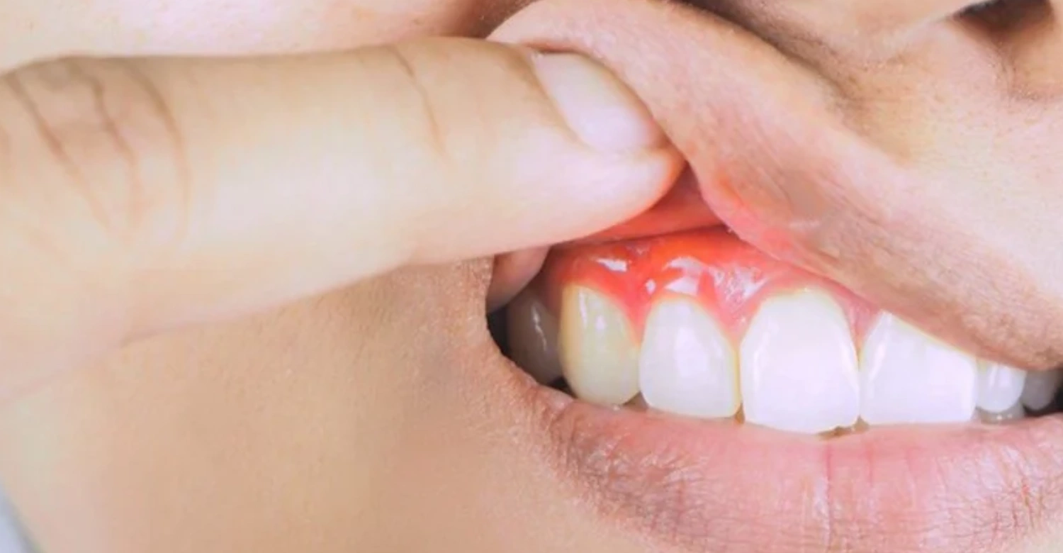 Swollen Gum and Loose Tooth Inblog
